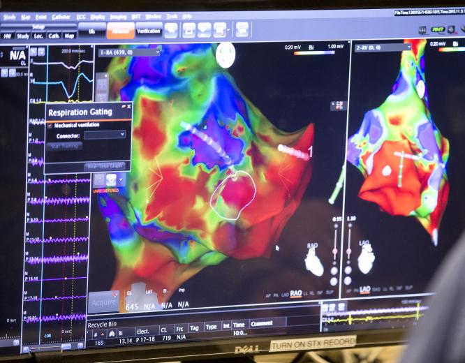 Arrhythmias (irregular or erratic heart rhythms) can lead to heart failure, stroke or cardiac arrest. That’s why cardiologists at UC Davis Medical Center aim to treat it efficiently and completely with a remotely operated magnet-guided catheter system — the first of its kind to be used in the Sacramento area. Arrhythmias (irregular or erratic heart rhythms) can lead to heart failure, stroke or cardiac arrest. That’s why cardiologists at UC Davis Medical Center aim to treat it efficiently and completely with a remotely operated magnet-guided catheter system — the first of its kind to be used in the Sacramento area.