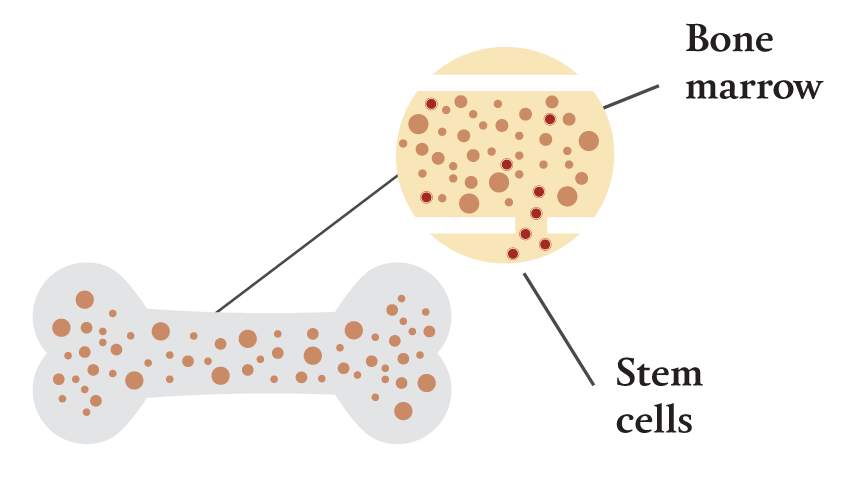 2.) The patient will have a blood draw, which will extract bone marrow stem cells. 